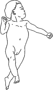 脳性麻痺