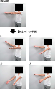 Barre〈バレー〉徴候陽性