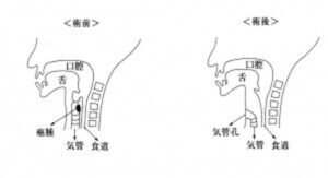 喉頭全摘出術と気管孔造設術